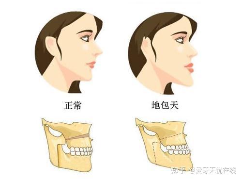 地包天整形多少錢要多久,地包天整形，費(fèi)用、時(shí)長及科學(xué)研究解析說明,穩(wěn)定評(píng)估計(jì)劃_Harmony16.59.78