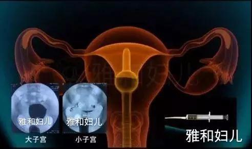 輸卵管起因的女性不孕癥